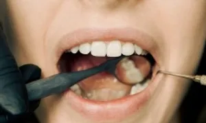 Tổn thương miệng lưỡi kéo dài cảnh báo ung thư
